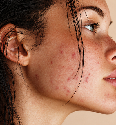 Acne-Prone Skin